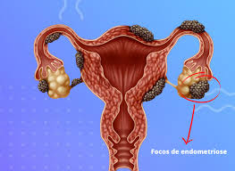 Endometriose: Entenda a Doença e Como a Alimentação Pode Ser Sua Aliada